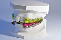 Herbstapparatur, McNamara