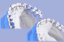 kleberetainer, bondedretainer