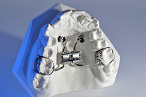 Hybrid GNE, Gaumennahterweiterung